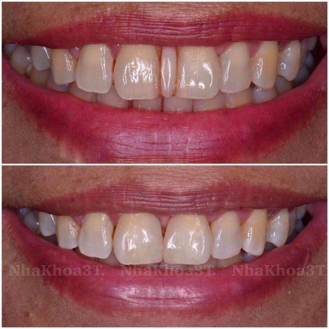 benh/rang-thua-340.html