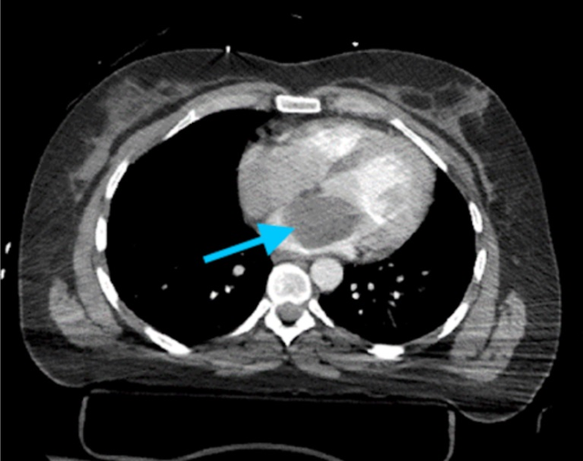 benh/u-trong-tim-374.html