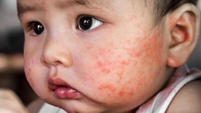 bai-viet/3-cach-tri-cham-sua-theo-dan-gian-me-nen-biet-62238.html