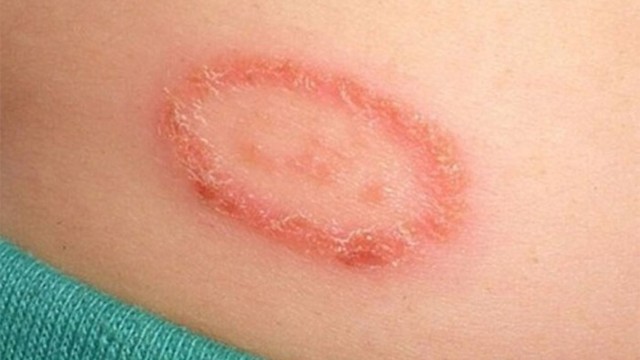 bai-viet/3-cach-tri-lac-dong-tien-don-gian-va-hieu-qua-nhat-64854.html