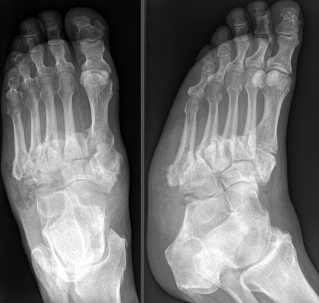 benh/benh-khop-do-than-kinh-41.html