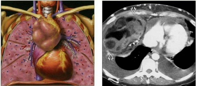 benh/u-trung-that-422.html