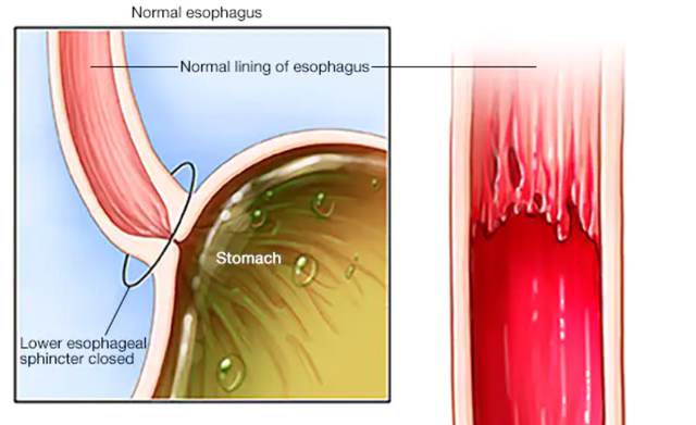 benh/barrett-thuc-quan-44.html
