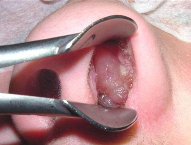 benh/polyp-mui-462.html