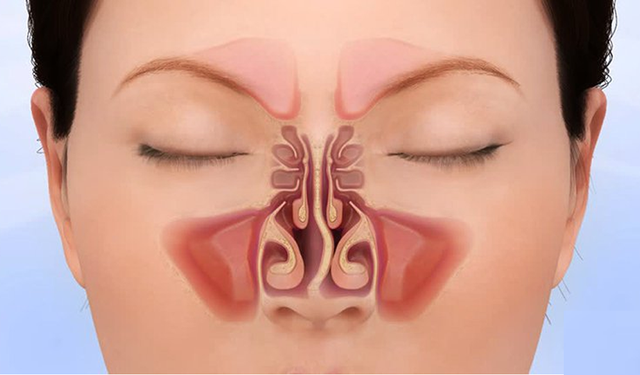 benh/veo-vach-ngan-mui-466.html