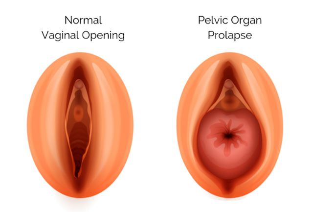 benh/sa-sinh-duc-495.html