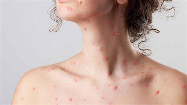 benh/da-bong-nuoc-tu-mien-pemphigus-519.html