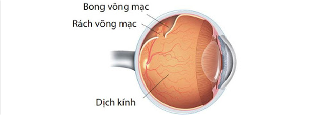 benh/bong-vong-mac-541.html