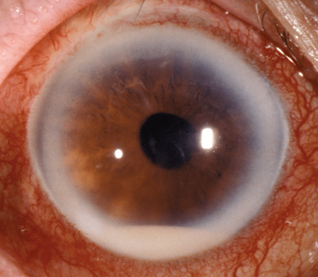 benh/viem-mu-noi-nhan-557.html