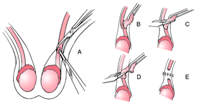 benh/that-ong-dan-tinh-569.html