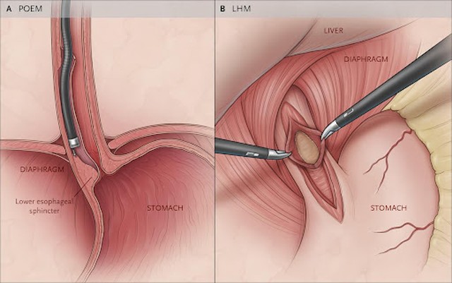 benh/co-that-tam-vi-577.html