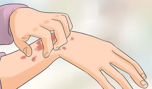 benh/ghe-coc-do-nhiem-treponema-pertenue-584.html