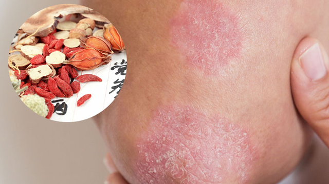 bai-viet/5-cach-chua-vay-nen-bang-dong-y-co-the-ban-chua-biet.html