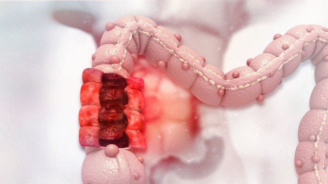 benh/viem-dai-trang-thieu-mau-cuc-bo.html