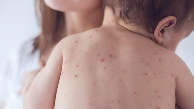 bai-viet/6-cach-phong-benh-tay-chan-mieng-hieu-qua-danh-cho-tre.html