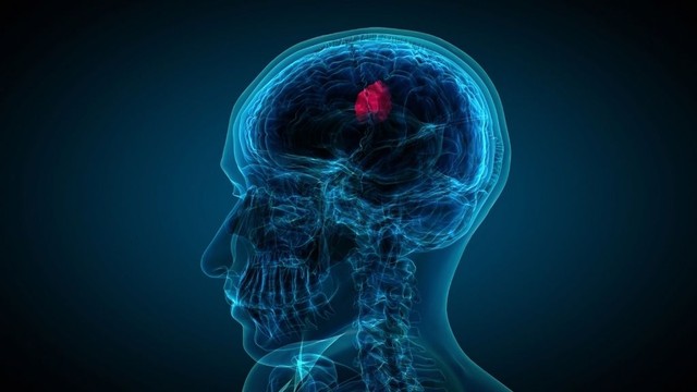 bai-viet/6-dau-hieu-u-nao-giai-doan-dau-khong-nen-chu-quan.html