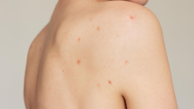 7 Nguyên nhân gây mụn lưng ở nữ giới và cách khắc phục