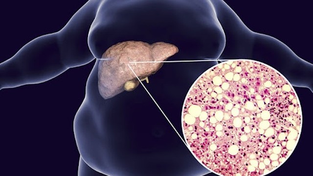 bai-viet/7-thuc-pham-giup-ban-lay-lai-su-can-bang-cho-gan-nhiem-mo-61233.html