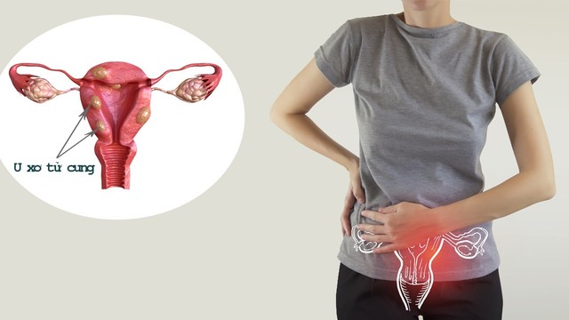 bai-viet/8-bien-chung-sau-khi-mo-u-xo-tu-cung-co-the-gap-ban-nen-biet-72598.html