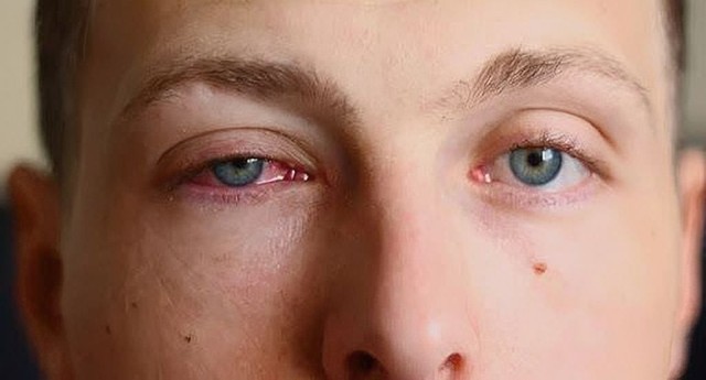 benh/viem-mang-bo-dao-983.html