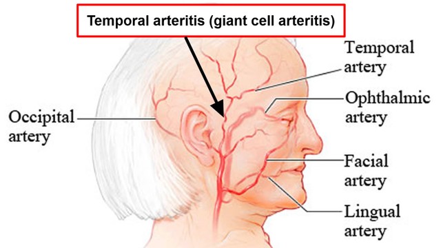 benh/benh-horton.html