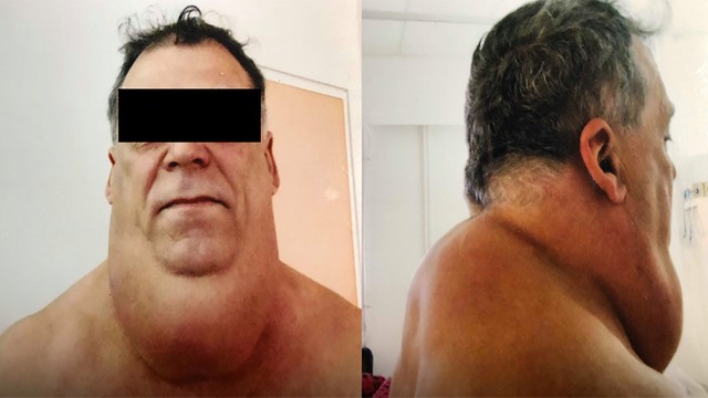 benh/benh-madelung.html