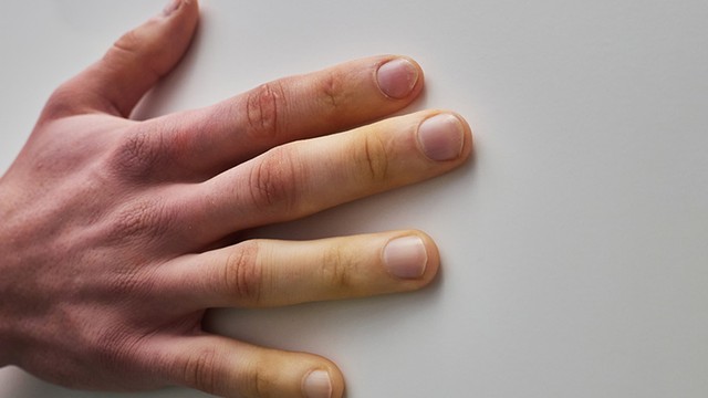 bai-viet/benh-xo-cung-bi-song-duoc-bao-lau.html