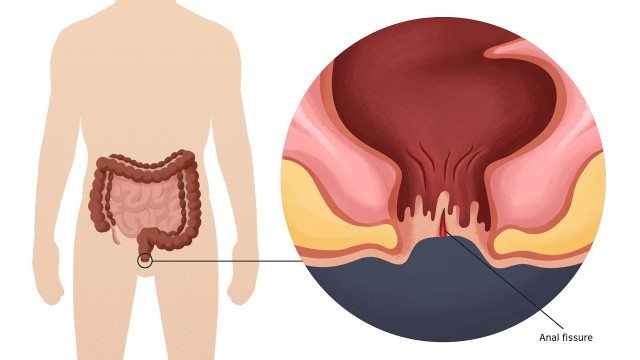 bai-viet/chay-mau-hau-mon-nhung-khong-dau-la-benh-gi.html