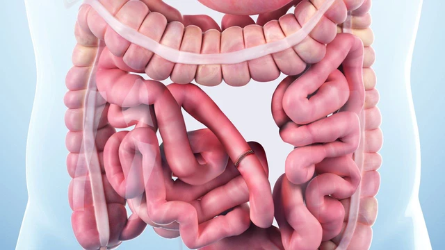 bai-viet/dieu-tri-tac-ruot-nhung-dieu-ban-can-biet.html