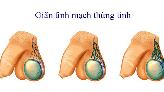bai-viet/gian-tinh-mach-thung-tinh-4mm-co-nguy-co-vo-sinh-khong.html