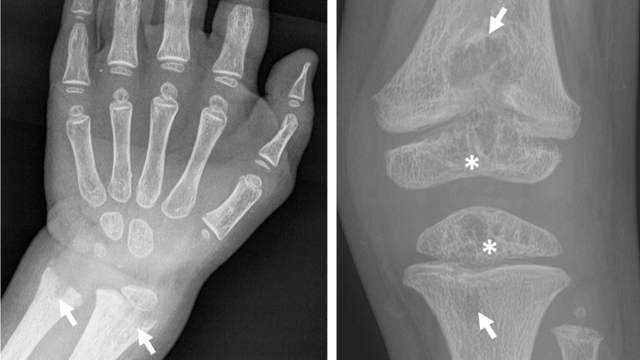 benh/benh-hypophosphatasia-hpp-bam-sinh.html