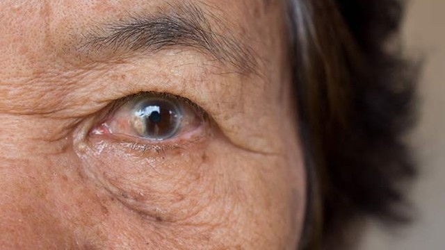 bai-viet/can-lam-gi-truoc-va-sau-khi-mo-phaco-cuom-mat.html