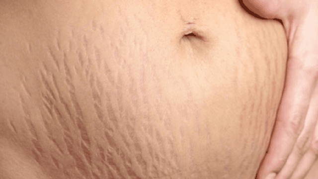 bai-viet/lam-sao-de-han-che-tinh-trang-ran-da-khi-mang-thai.html