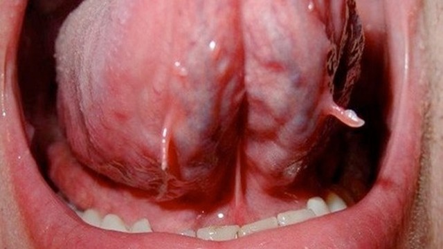 bai-viet/nguyen-nhan-lam-cho-mat-duoi-luoi-co-soi-thit.html