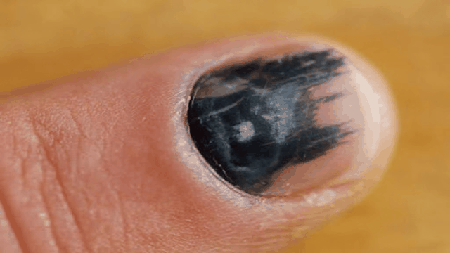 bai-viet/mong-tay-den-la-bieu-hien-cua-benh-gi.html