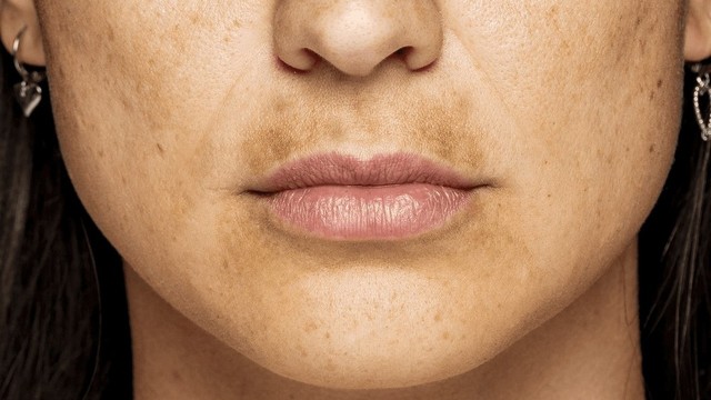 bai-viet/nam-da-quanh-mieng-nguyen-nhan-va-cach-dieu-tri.html