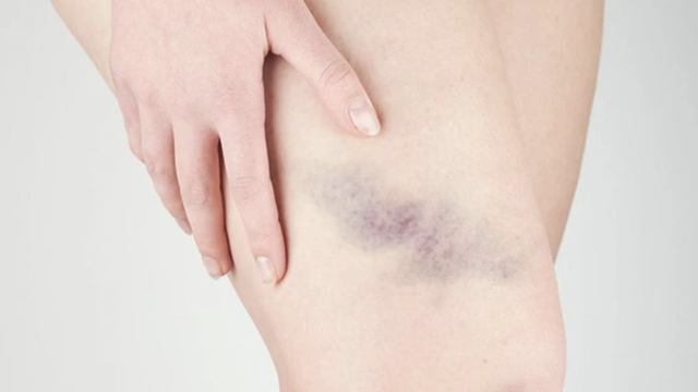 bai-viet/ngua-gai-bi-bam-tim-va-nhung-dieu-can-biet.html