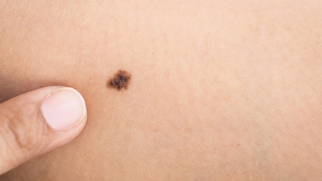 bai-viet/not-ruoi-hinh-thanh-the-nao-nguyen-nhan-va-cach-phan-loai.html