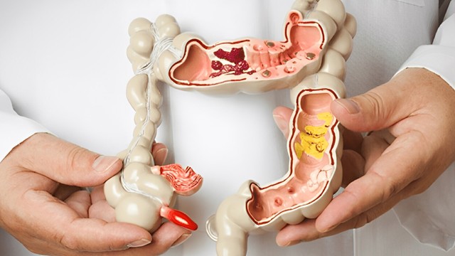 bai-viet/cach-phan-biet-tri-va-ung-thu-hau-mon.html