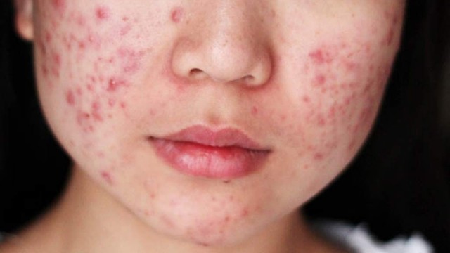 bai-viet/seo-do-mun-trung-ca-dieu-tri-nhu-the-nao.html