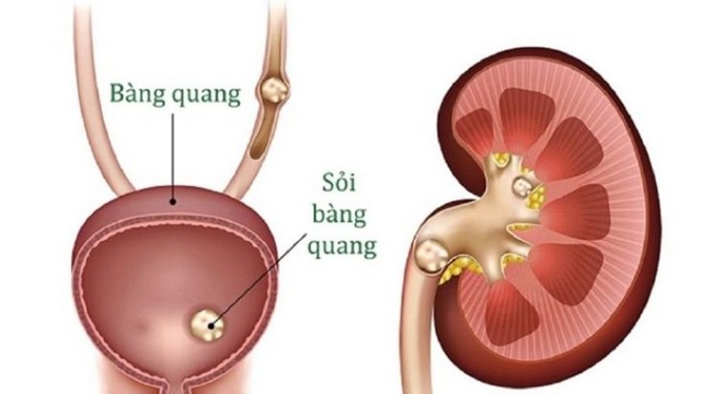 bai-viet/soi-bang-quang-uong-thuoc-gi-mau-khoi-bien-phap-phong-ngua.html
