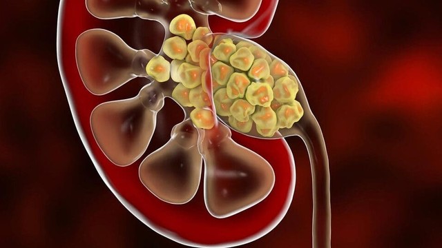 bai-viet/soi-than-4mm-co-nguy-hiem-hay-khong-nhung-luu-y-voi-nguoi-co-soi-than-4mm.html