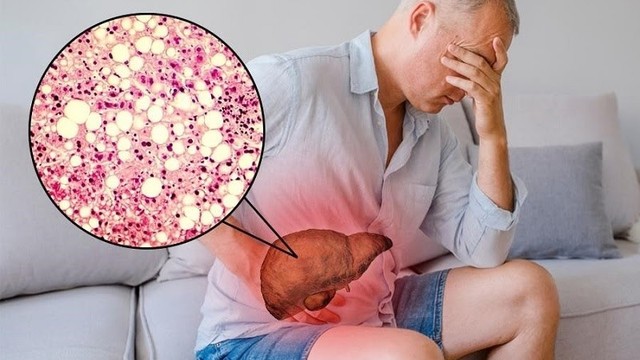 bai-viet/men-gan-cao-co-nguy-hiem-khong-can-lam-gi-de-ha-men-gan.html