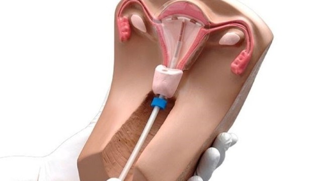 bai-viet/thao-vong-tranh-thai-co-dau-khong-bien-chung-xay-ra-sau-khi-thao-vong.html