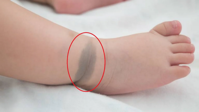 bai-viet/tinh-trang-bot-sac-to-o-da-phan-loai-nguyen-nhan-va-cach-dieu-tri.html