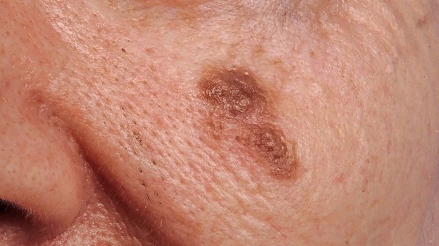 benh/ung-thu-te-bao-hac-to.html