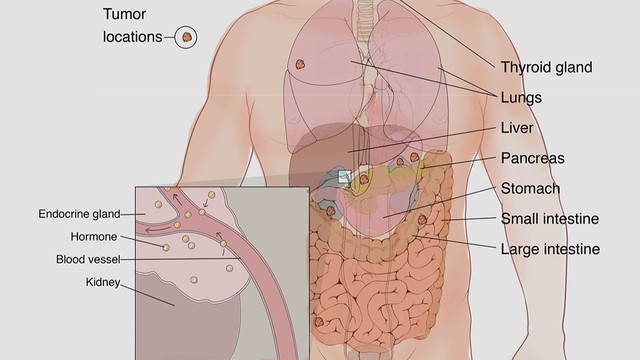 benh/u-than-kinh-noi-tiet.html
