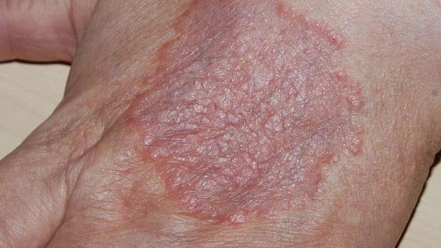 bai-viet/u-hat-vong-co-nguy-hiem-khong-nguyen-nhan-va-phuong-phap-dieu-tri.html