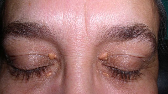 bai-viet/u-vang-xanthoma-dau-hieu-canh-bao-roi-loan-lipid-mau.html