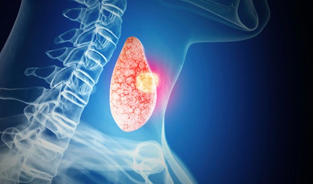 bai-viet/ung-thu-tuyen-giap-di-can-hach-co-dau-hieu-va-cach-dieu-tri.html